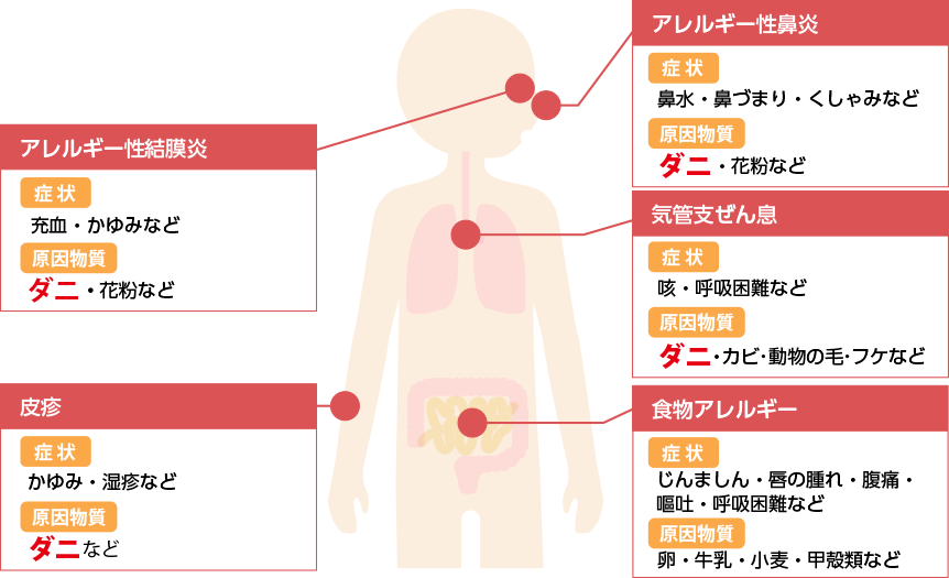 アレルギーの主な原因と経路